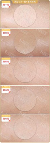 脱毛机十大名牌排行榜(商用脱毛机品牌排行)插图26