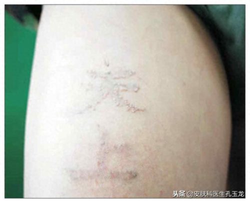 扁平疣十大药水排行榜(扁平疣首选药)插图4