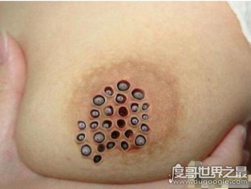 密集恐惧症大揭秘(密集恐惧症普遍么)插图3