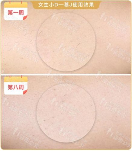 脱毛机十大名牌排行榜(商用脱毛机品牌排行)插图17