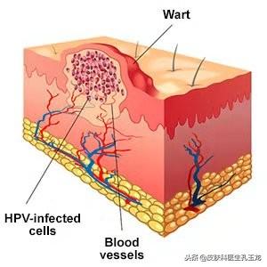 扁平疣十大药水排行榜(扁平疣首选药)插图1