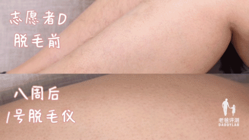 脱毛机十大名牌排行榜(商用脱毛机品牌排行)插图11