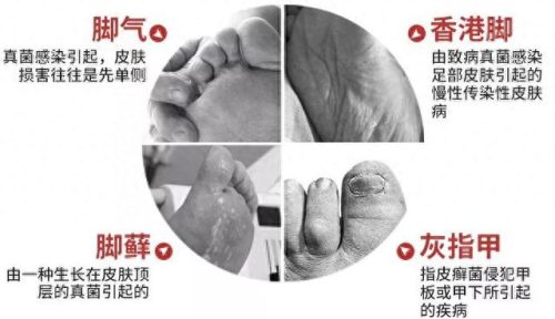 脚气药十大排行榜 进口(进口脚气药排行榜)插图13