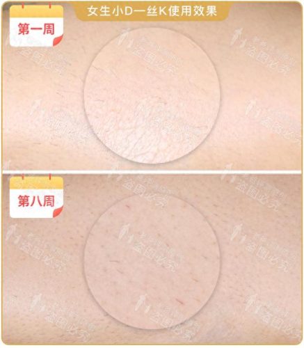 脱毛机十大名牌排行榜(商用脱毛机品牌排行)插图18