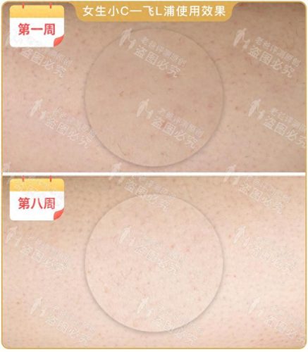 脱毛机十大名牌排行榜(商用脱毛机品牌排行)插图12