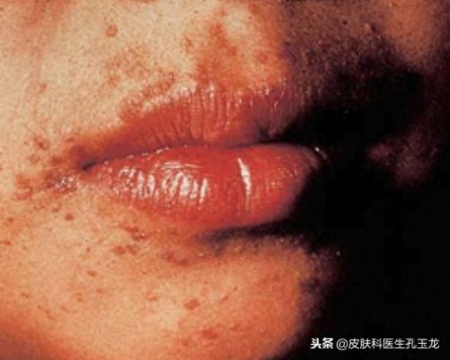扁平疣十大药水排行榜(扁平疣首选药)插图6