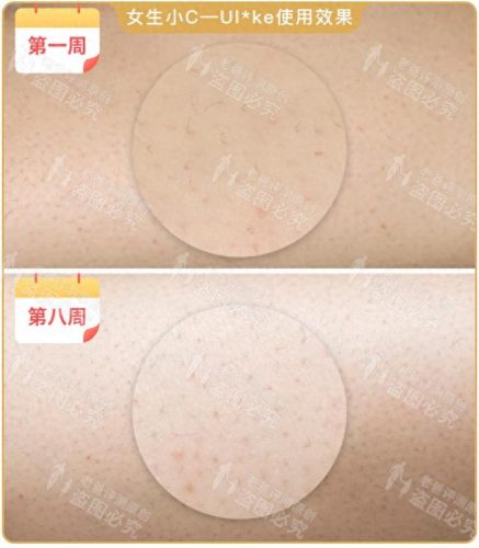 脱毛机十大名牌排行榜(商用脱毛机品牌排行)插图15