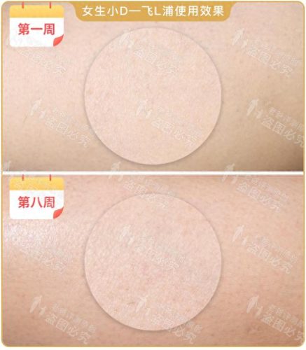 脱毛机十大名牌排行榜(商用脱毛机品牌排行)插图16