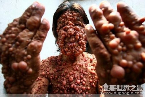 密集恐惧症大揭秘(密集恐惧症普遍么)插图7