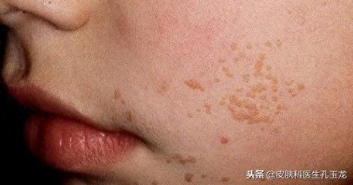 扁平疣十大药水排行榜(扁平疣首选药)插图3