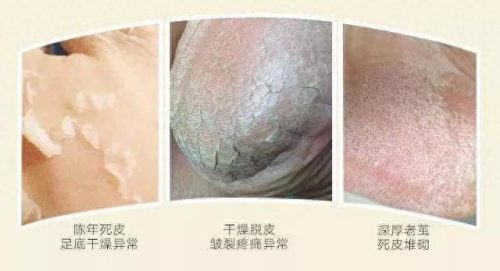 脚气药十大排行榜 进口(进口脚气药排行榜)插图14