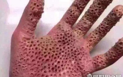 密集恐惧症大揭秘(密集恐惧症普遍么)