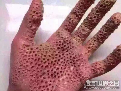 密集恐惧症大揭秘(密集恐惧症普遍么)插图