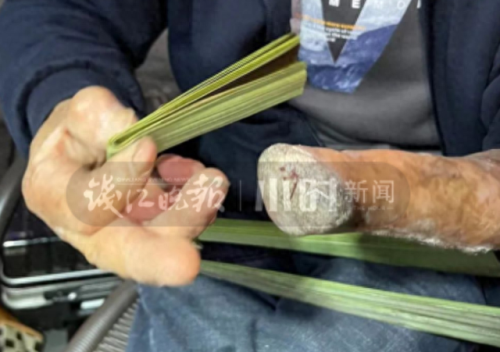 浙江硅胶假肢公司排名前十(浙江仿真上肢假肢品牌)插图5
