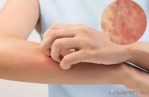 湿疹药膏排名前十(湿疹药膏十大排行榜)插图