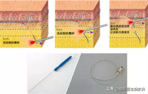激光溶脂瘦腿(小腿吸脂减肥)插图3