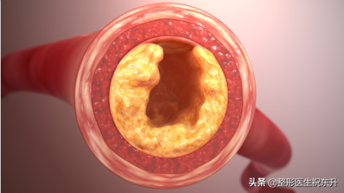 激光溶脂瘦腿(小腿吸脂减肥)插图1