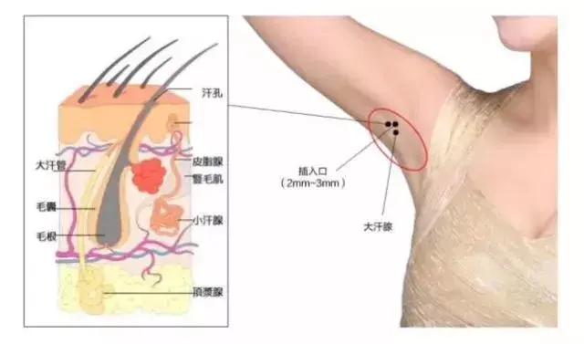 腋下除臭针有效吗(腋下减针的最佳方法)插图6