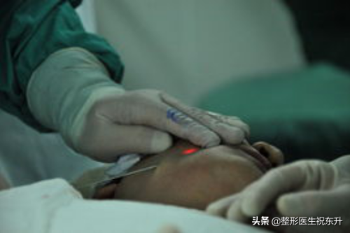 激光溶脂瘦腿(小腿吸脂减肥)插图