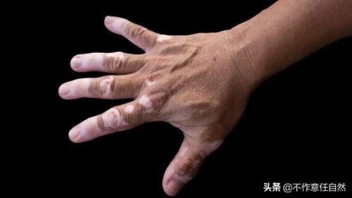 杰克逊为什么变白(mj是怎么变白的)插图1