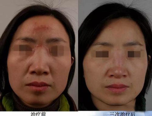 激光美容哪家医院最好(三甲医院激光收费标准)插图4