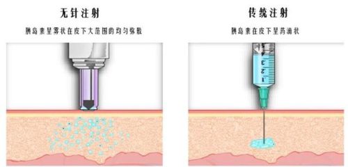 无针注射器(无针注射器九大危害)插图5