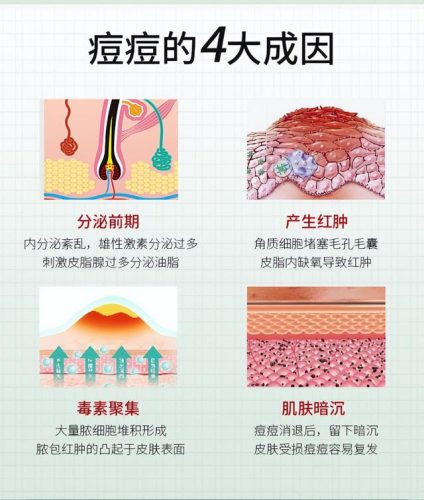 痘产品排行榜10强(祛痘最好用的产品)插图3