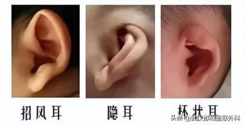 耳朵畸形医院排名前十(宝宝耳朵怎样就算畸形)插图3