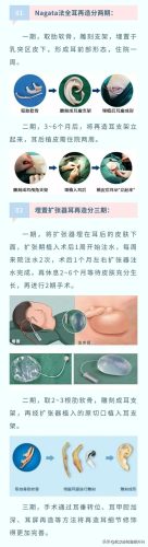 耳朵畸形医院排名前十(宝宝耳朵怎样就算畸形)插图7