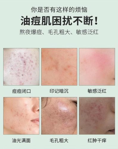 祛痘排行榜第一名药膏(去青春痘的药膏最好排名)插图3