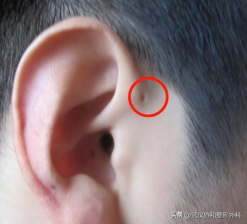 耳朵畸形医院排名前十(宝宝耳朵怎样就算畸形)插图4