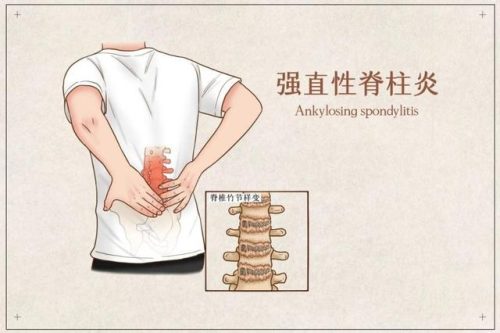 治疗强直医院排行榜(强直医院哪家最好的医院在哪里)插图