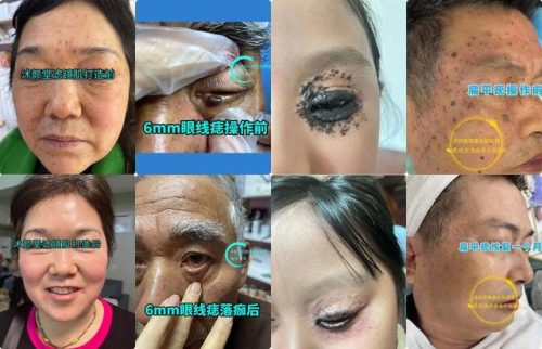 祛斑祛痣店加盟排行榜10强(面康痣斑王加盟费多少)插图2