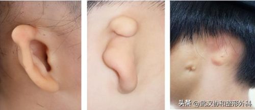 耳朵畸形医院排名前十(宝宝耳朵怎样就算畸形)插图2