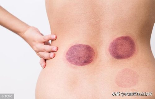 拔火罐拔出水泡(拔罐后出现水泡怎么处理)插图