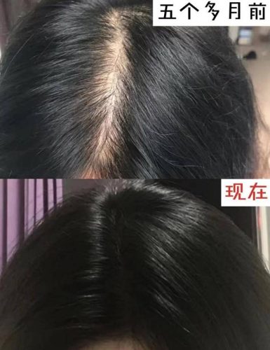脱发产品排行榜(公认最有效的生发产品)插图3