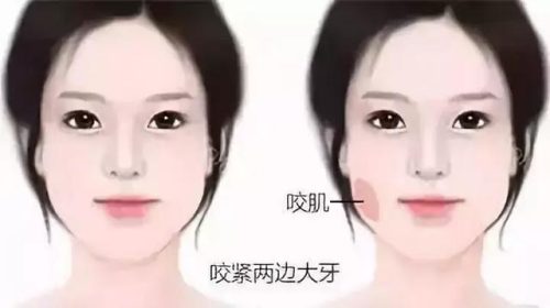 进口瘦脸针牌子排行榜(瘦脸针打什么牌子的好)插图2