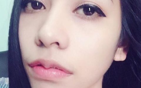 瘦唇手术(做m唇手术能维持多久)